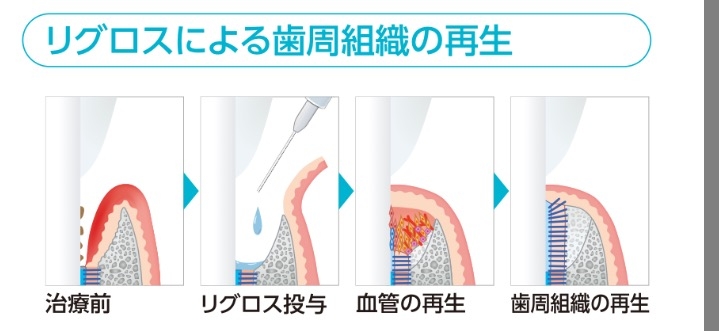 リグロスは、歯周組織の周囲にある細胞を増やしさらに血管を作って細胞に栄養を送り込みます。これらの作用により歯を支えている骨などの歯周組織が再生されます。  